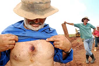  	Ferimento no peito de trabalhador rural, causado por bala de borracha disparada pela PM a serviço privado da Usina Ester (Foto: Joao Zinclar 15/12/09)